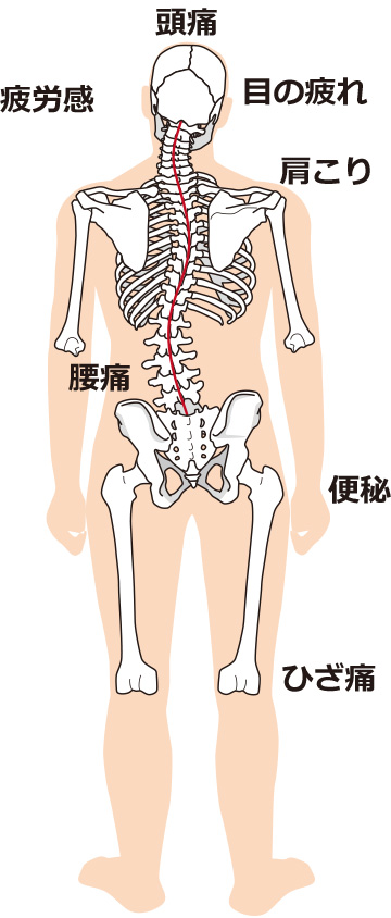 骨格の歪みと体の不調を示す図。頭痛、疲労感、目の疲れ、肩こり、腰痛、便秘、ひざ痛。
