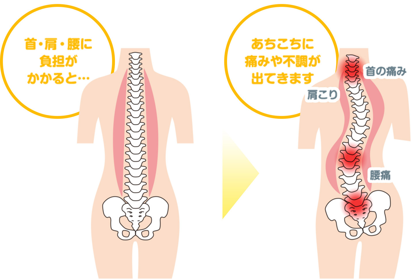 首・肩・腰に負担がかかると、肩こり、首の痛み、腰痛など、あちこちに痛みや不調が出ることを示す図。
